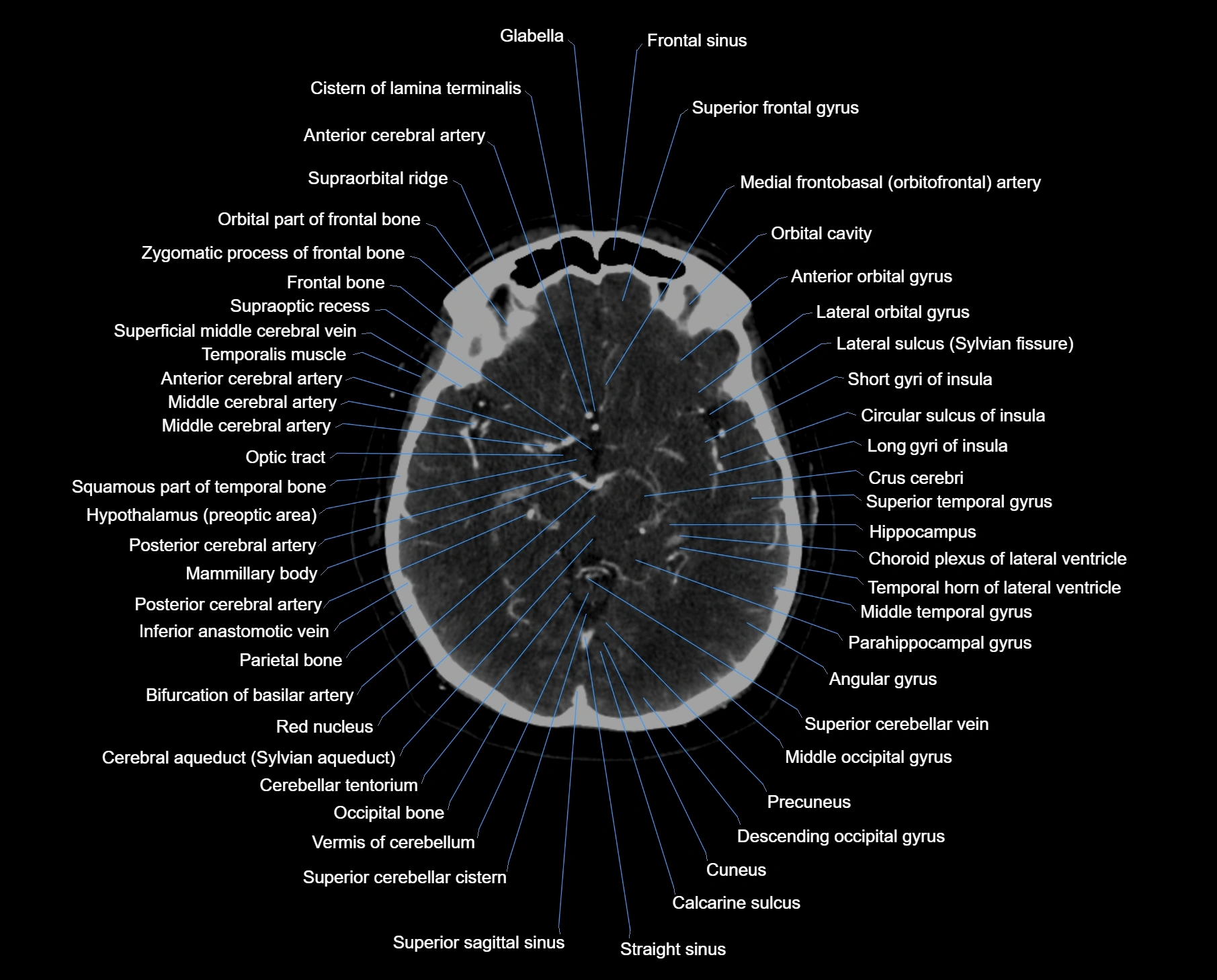 CT scan brain axial labelled cross sectional anatomy image-img-000030.webp